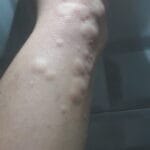 Kaşıntı ve Kabarma