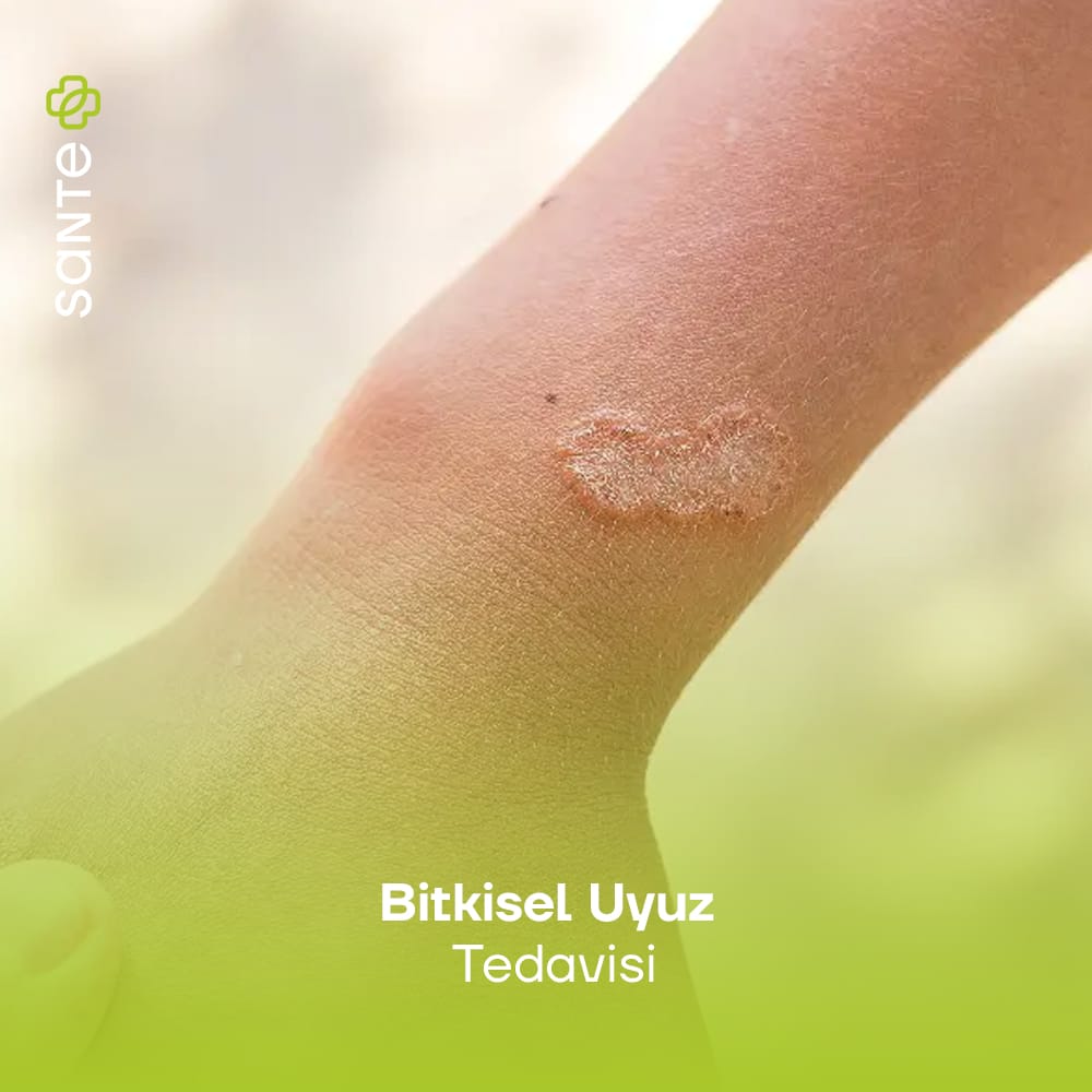 Bitkisel Uyuz Tedavisi