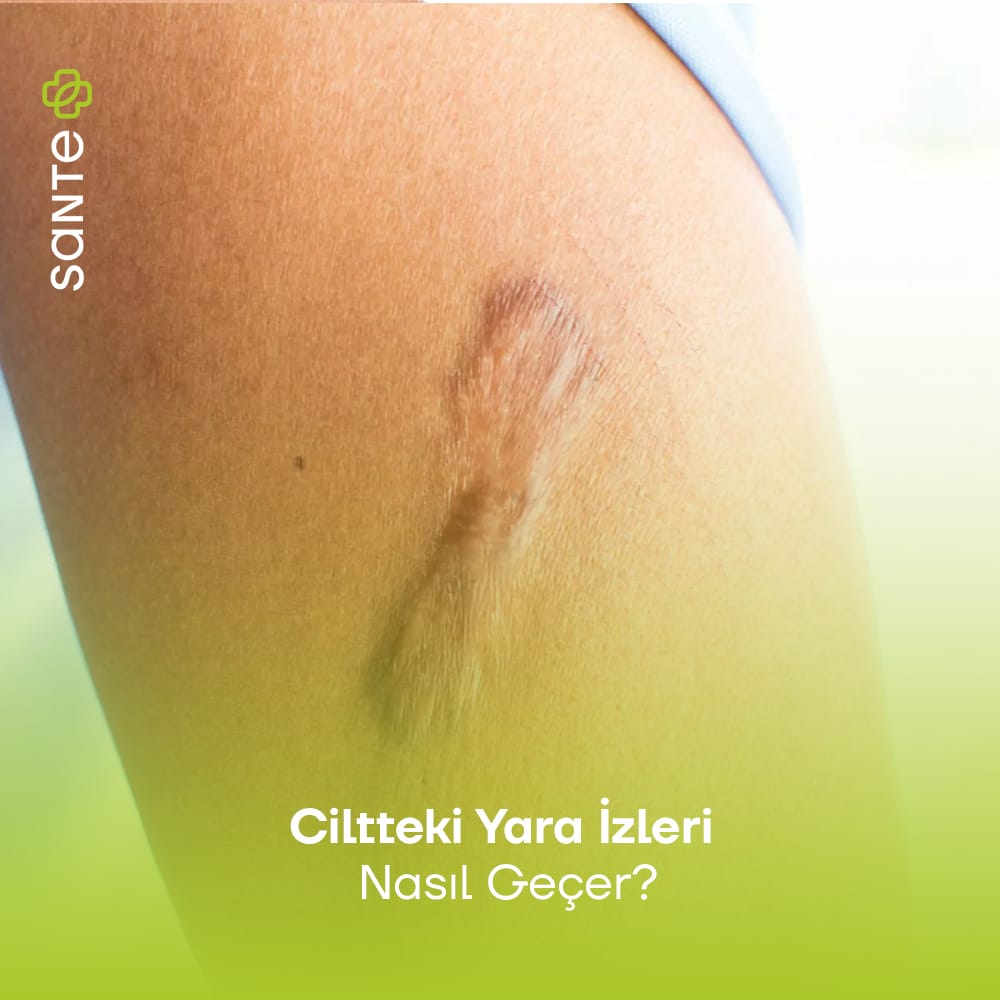 Ciltteki Yara İzleri