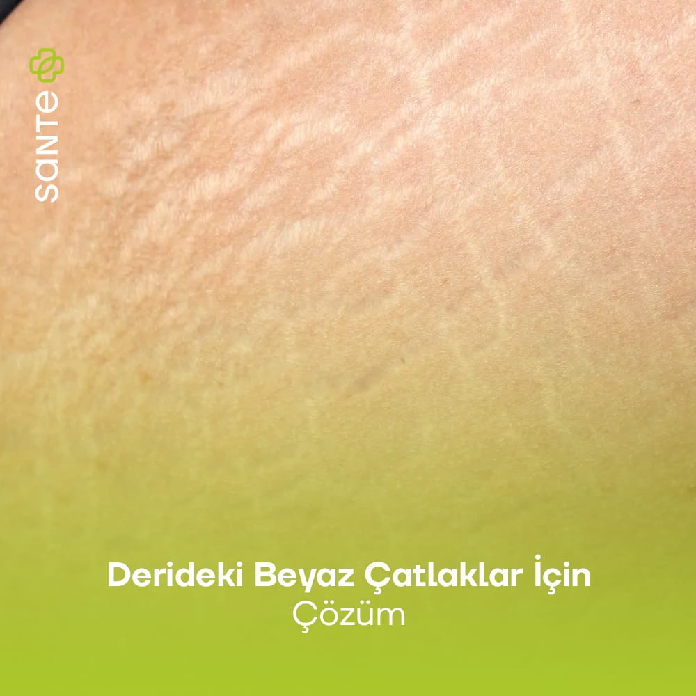 Derideki Beyaz Çatlaklar Nasıl Geçer