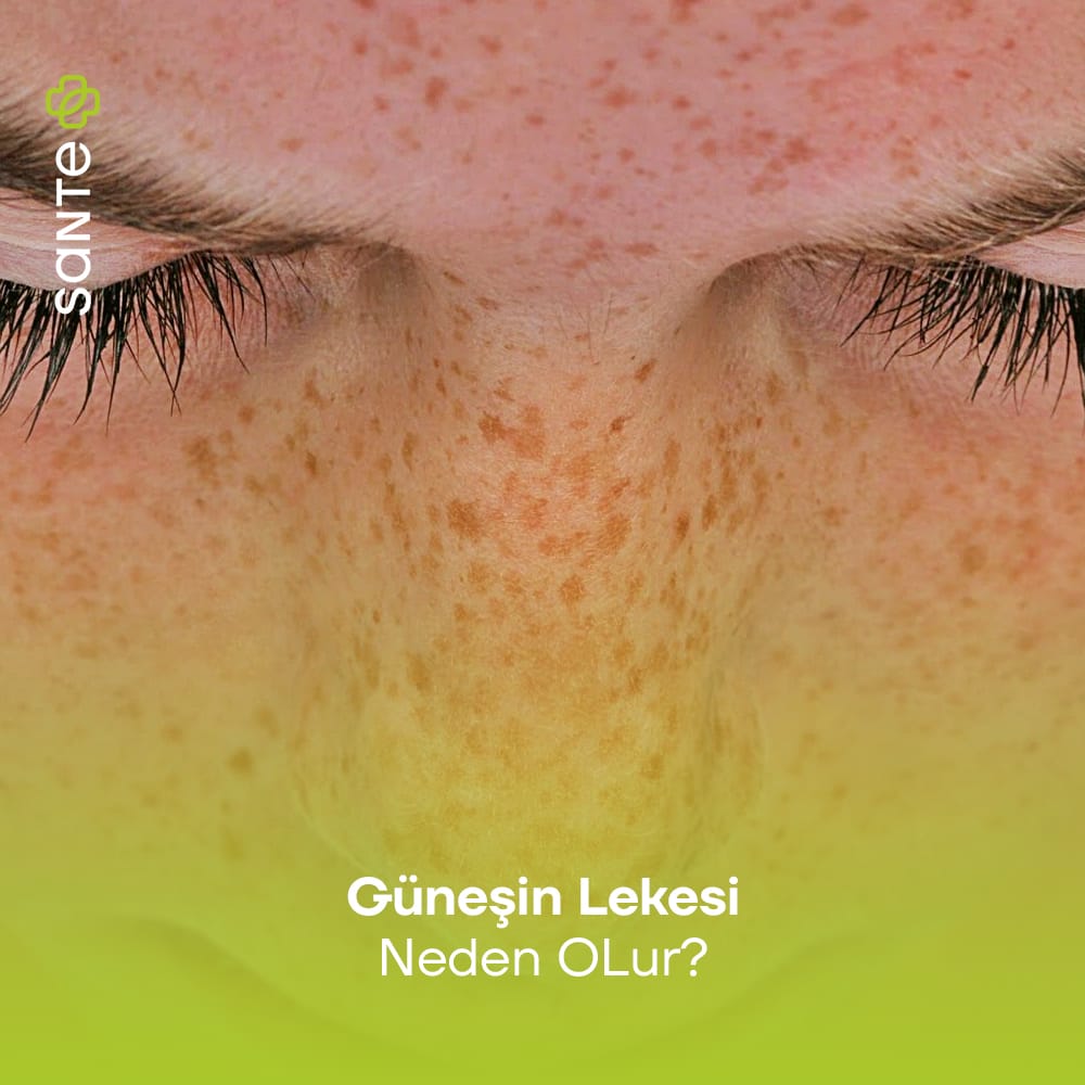 Güneş Lekesi Neden Olur
