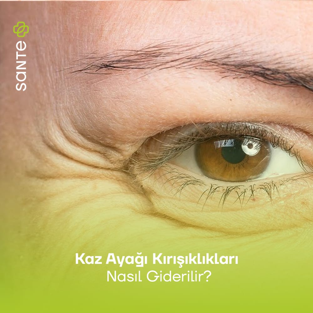 Kaz Ayağı Kırışıklıkları Nasıl Giderilir