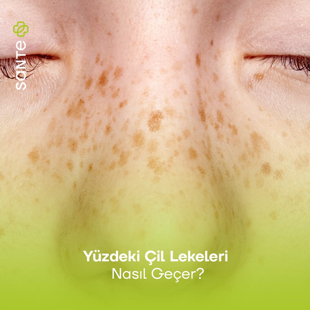 Yüzdeki Çil Lekeleri