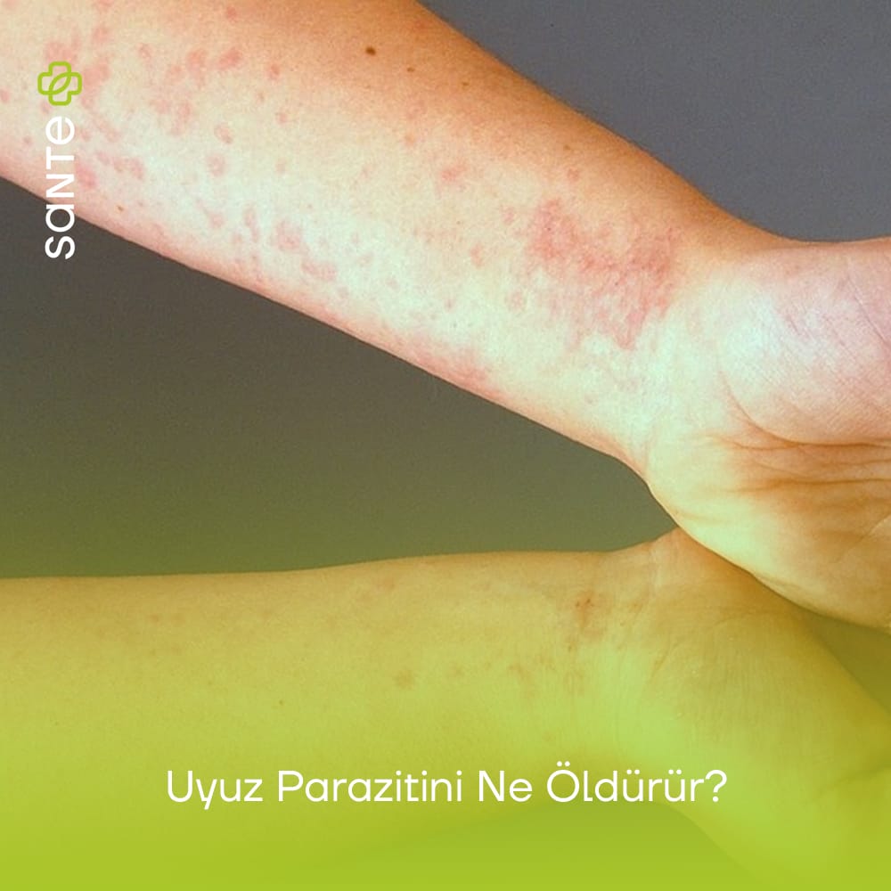 Uyuz Parazitini Ne Öldürür