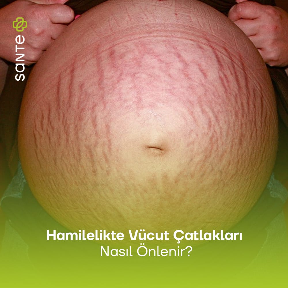 Hamilelikte Vücut Çatlakları