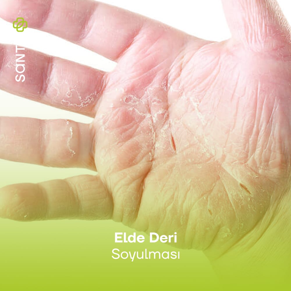 Elde Deri Soyulması