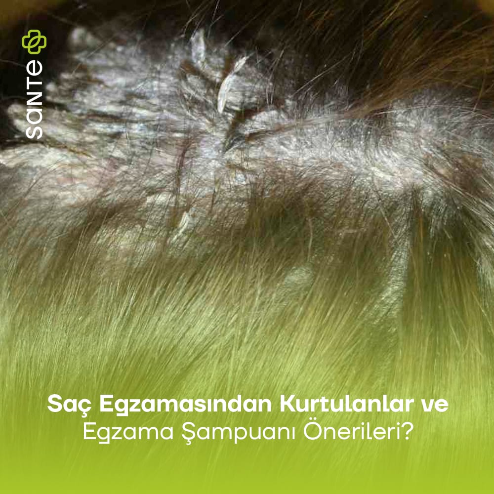 Saç Egzamasından Kurtulanlar ve Egzama Şampuanı Önerileri