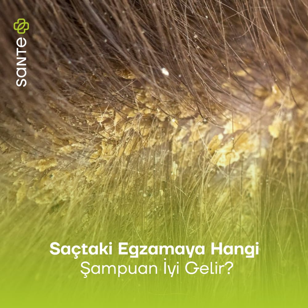 Saçtaki Egzamaya Hangi Şampuan İyi Gelir