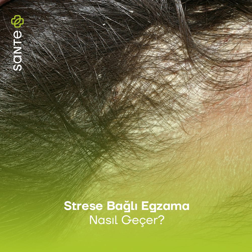 Strese Bağlı Egzama Nasıl Geçer