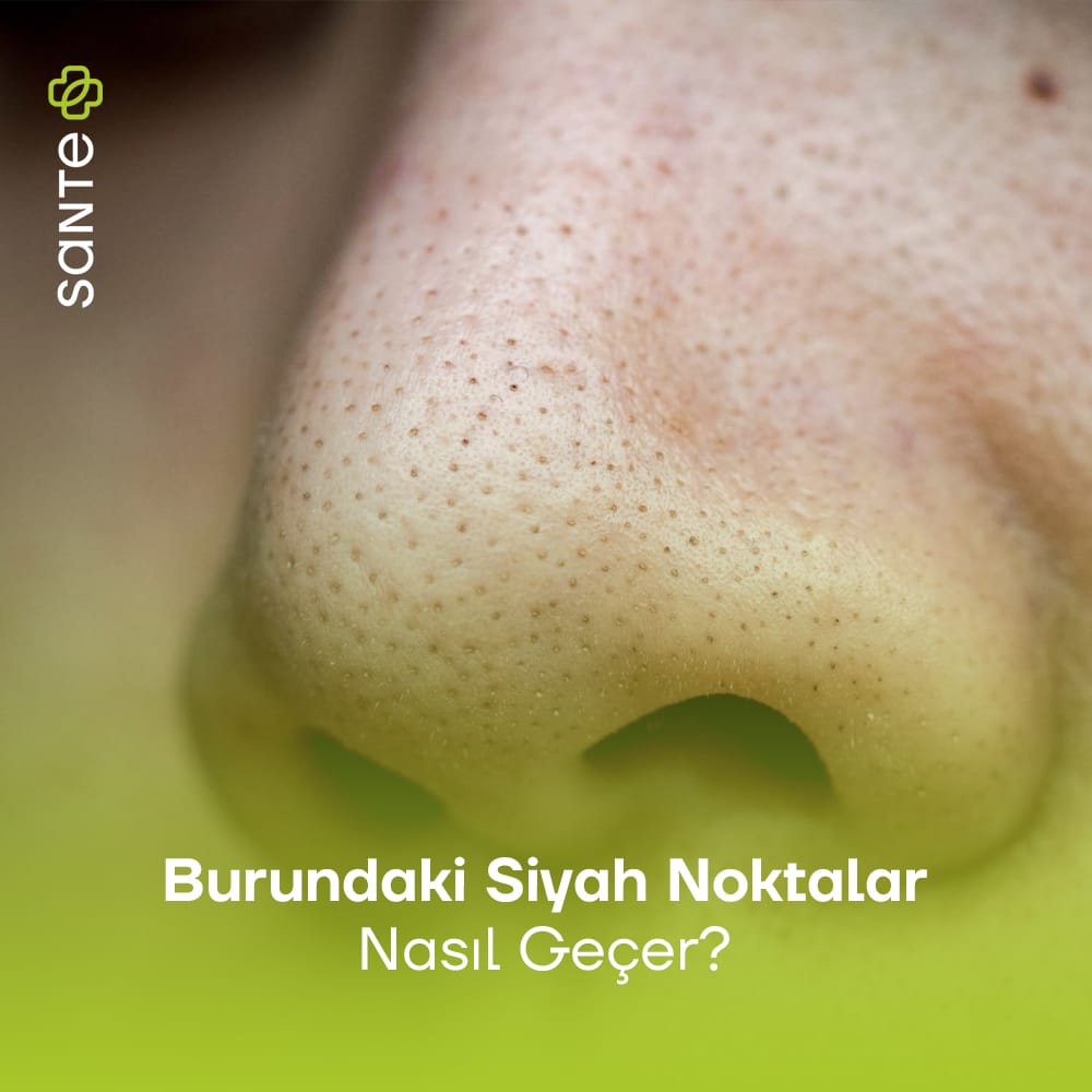Burundaki Siyah Noktalar Nasıl Geçer