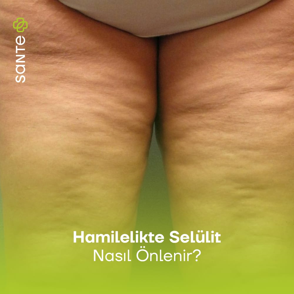 Hamilelikte Selülit Nasıl Önlenir