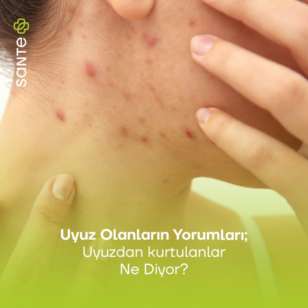 Uyuz Olanların Yorumları Uyuzdan Kurtulanlar Ne Diyor