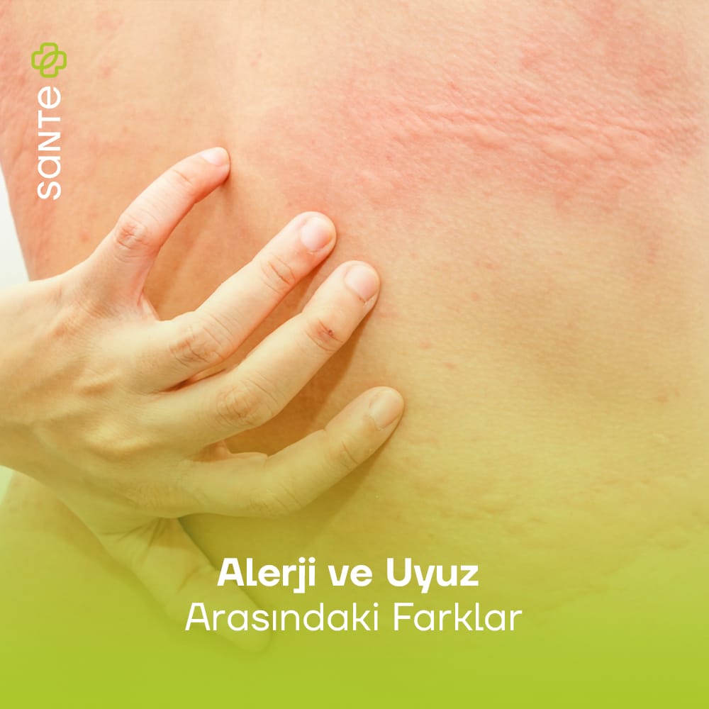 Alerji ve Uyuz Arasındaki Farklar