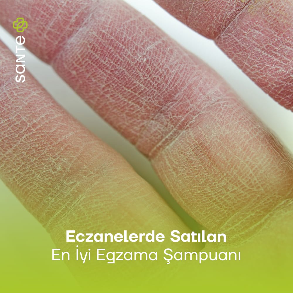 Sante Plus Eczanelerde Satılan En İyi Egzama Şampuanı