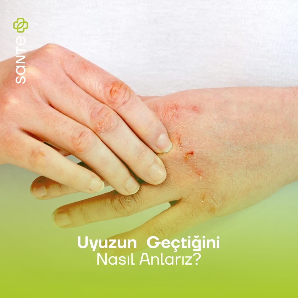Sante PLus Uyuzun Geçtiğini Nasıl Anlarız